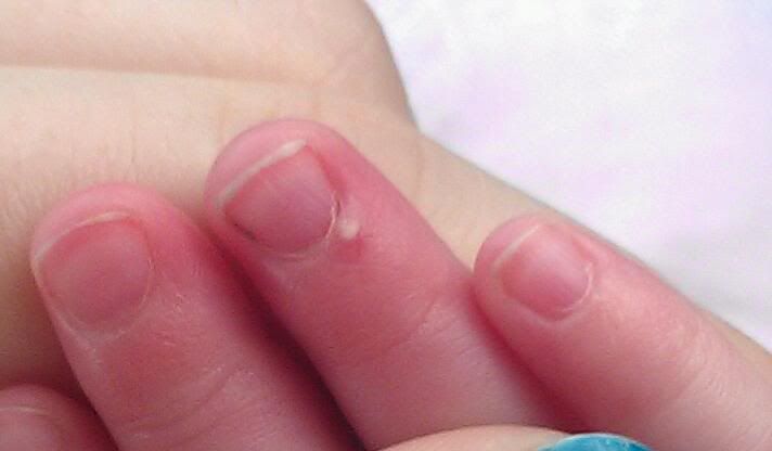 white-bump-on-finger-babycenter